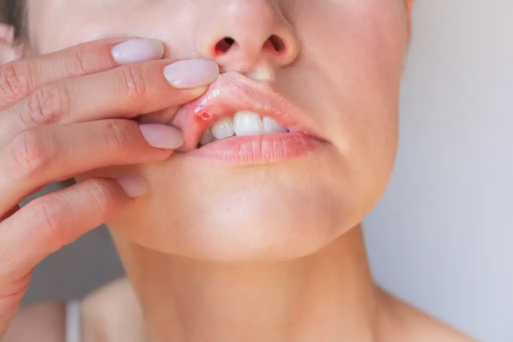 Kako se znebiti razpokanih ustnic za vselej?